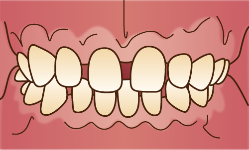 空隙歯列