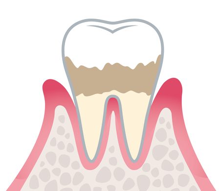 軽度歯周炎
