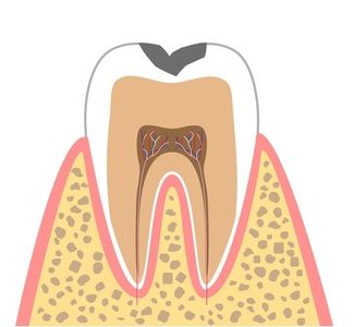 C1（エナメル質のむし歯）