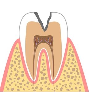 C2（象牙質に達したむし歯）