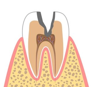 C3（神経に達したむし歯）